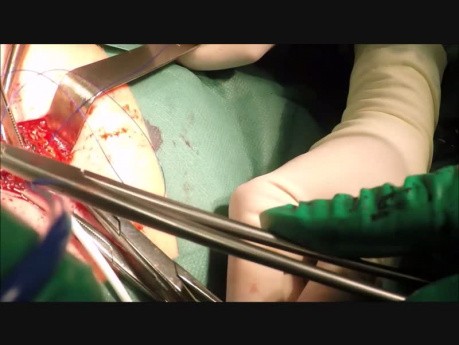 Umbilical Hernia Repair with Synthetic Mesh