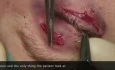 Maxillo Zygomatic Complex Fracture Open Reduction Internal 3 Points Fixation