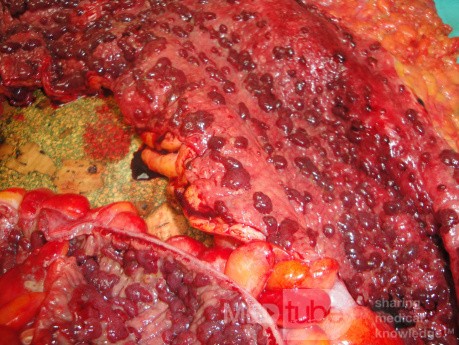 Multiple Rectal Ulcers (85 of 110)