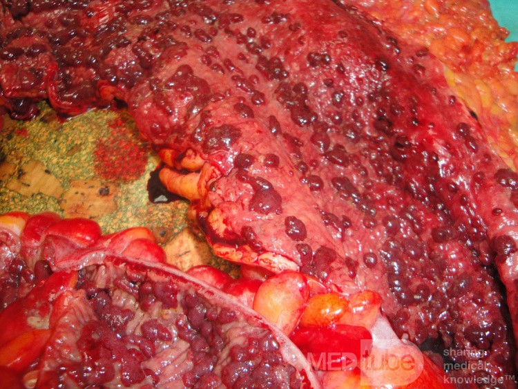 Multiple Rectal Ulcers (85 of 110)