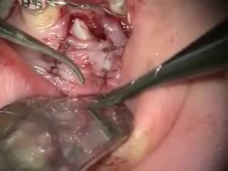 Exposure Of Upper Cuspid