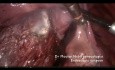 Cervico Isthmic Myomectomy on Scar Abdomen