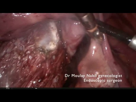 Cervico Isthmic Myomectomy on Scar Abdomen