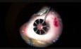 Aniridia Partial Iris Implantation with Cataract Removal in the Eye with Congenital Aniridia, Cataract, High Myopia and Nystagmus