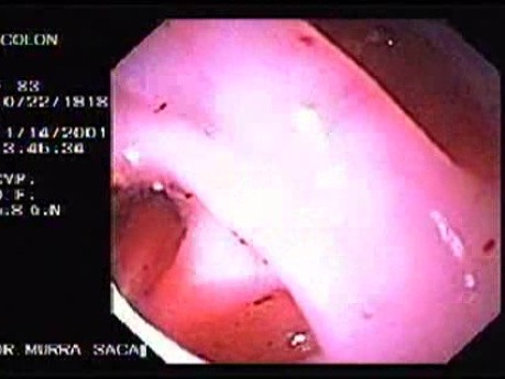 Diverticular Disease - Hemorrhage (10 of 15)