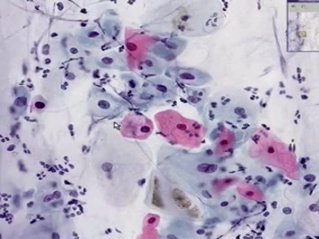 Low grade squamous intraepithelial l - Histopathology - Cervix