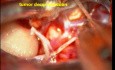 Brain tumor-Trigeminal Schwannoma - Microsurgical Excision