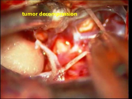 Brain tumor-Trigeminal Schwannoma - Microsurgical Excision
