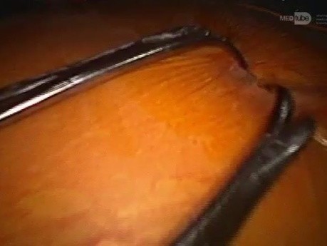 IPOM Hernioplasty