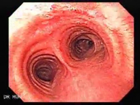 Bronchoscopy