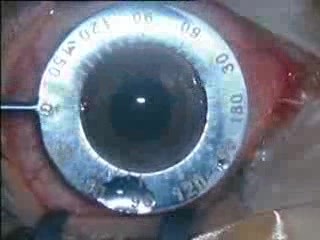 Phacoemulsification