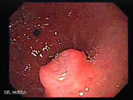 Eosinophilic Esophagitis - Ectopic Pancreas - 1/3
