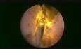 GreenLEP - Greenlight Enucleation of the Prostate
