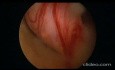 Endometrial Polyp and Submucous Fibroid