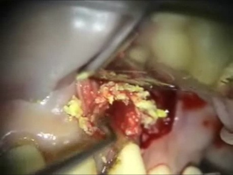 Endo/Perio Microsurgery