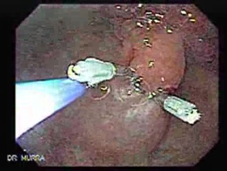 Multilobulated Gastric Polyp (8 of 20)