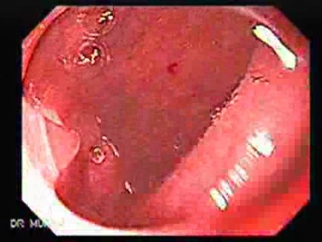 Celiac Disease - Duodenal Mucosa (4 of 5)