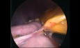 SASI Procedure - Loop Bipartition with Sleeve Gastrectomy for Type 2 Diabetes