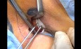 Chemoport: Central Venous Access Device (CVAD) Insertion