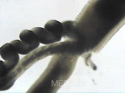 Trichuris Trichuris (whipworm) (7 of 19)