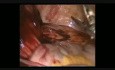 Laparoscopic Treatment Of A Large Gossypiboma Complicated With Penetration Of The Intestinal Wall