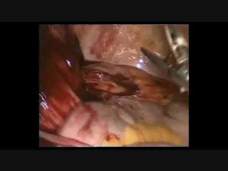 Laparoscopic Treatment Of A Large Gossypiboma Complicated With Penetration Of The Intestinal Wall