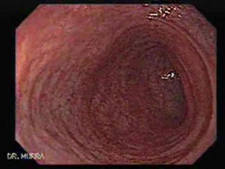 Rectal Adenocarcinoma - Colonoscopy (6 of 8)