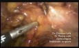Unroofing of Ureter During C1 Radical Hysterectomy