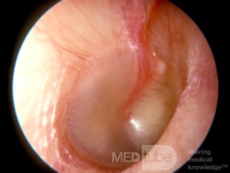 Mucoid Otitis Media