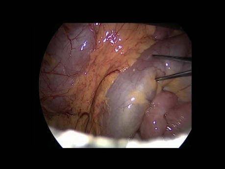 Jejuno-Jejunal Anastomosis Stump Resection