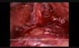 Laparoscopic Cholecystectomy in Patient with Gallstones and Liver Cirrhosis 