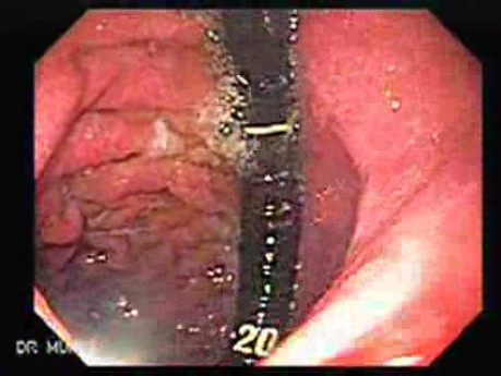 Two Ulcers in a Cirrhotic Patient - Follow Up Endoscopy, Part 2