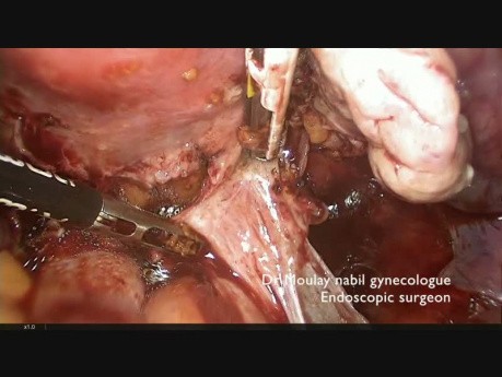 Laparoscopic Total Hysterectomy using the BiCision Device