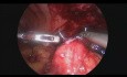 Laparoscopic Ceacocutaneous Fistula (Post Appendectomy) Excision