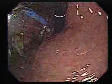 Presentation of the Balloon in the Gastric Fundus