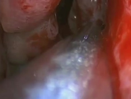 Revision Of The Sinuses - FESS