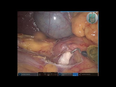 Low Cost Technical Standardization of the Right Colectomy by Robotic Surgery