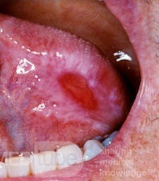 Solitary Giant Apthous Ulcer