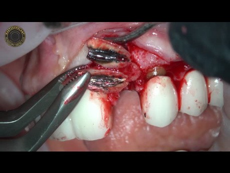 Advanced Laser Surgery in Oral Implantology