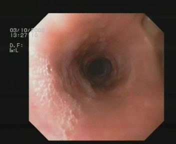 Esophageal Diverticula