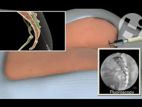 Caudal Procedure
