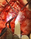 Surgical Planning with Neuronavigator in Patient with Intracranial Mass Lesion. High Grade Glioma.
