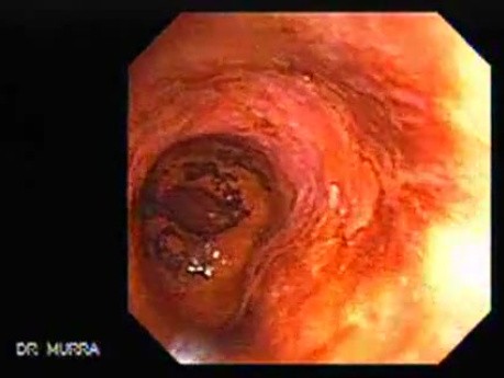 Barrett's Esophagus of long segment (18 of 24)