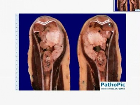 Osteosarcoma - Histopathology - Bone