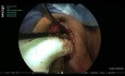 'Non-Robotic' Video-Handoscopic Assisted Trans-Axillary Hemithyroidectomy: A Novel Concept