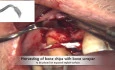 Implant Placement With Simultaneous Bone Augmentation - Case 2