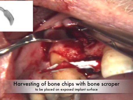 Implant Placement With Simultaneous Bone Augmentation - Case 2