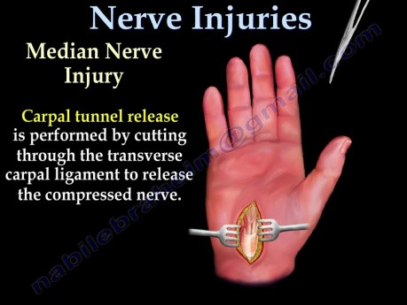 Cubital Tunnel Syndrome  And Nerve Injuries - Teaching Video