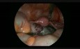 Laparoscopic Surgery For Adnexal Torsion