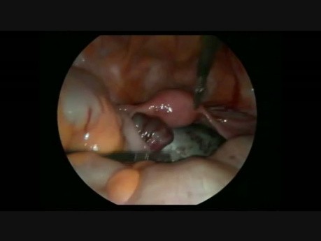 Laparoscopic Surgery For Adnexal Torsion